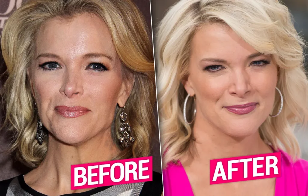 Megyn Kelly Before And After Face Photo