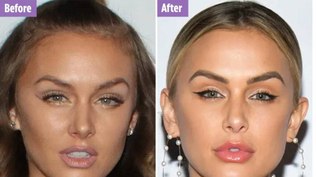 Lala Kent Plastic Surgery