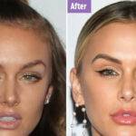 Lala Kent Plastic Surgery