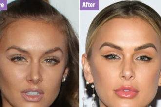 Lala Kent Plastic Surgery