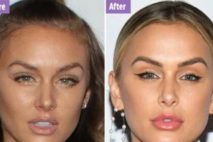 Lala Kent Plastic Surgery