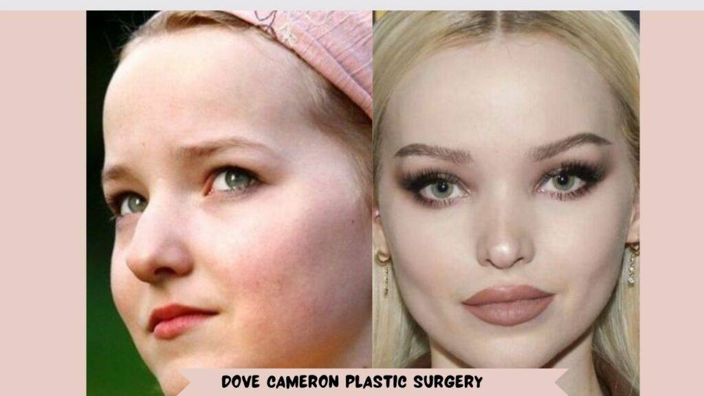Dove Cameron Plastic Surgery