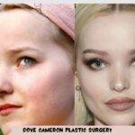 Dove Cameron Plastic Surgery